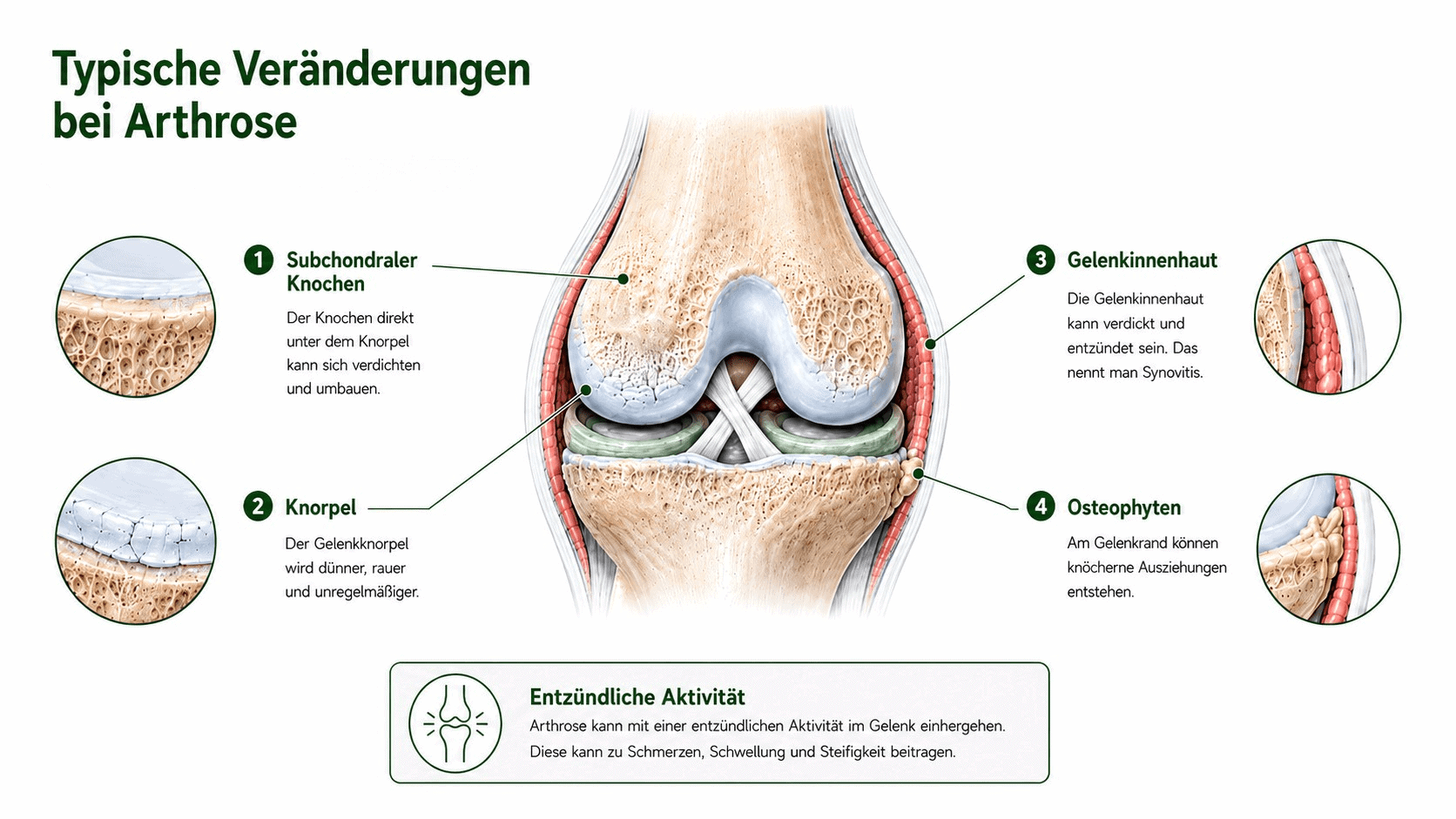 Infografik: Kniearthrose betrifft Knorpel, Knochen, Gelenkinnenhaut, Meniskus, Kapsel, Bänder und Muskulatur