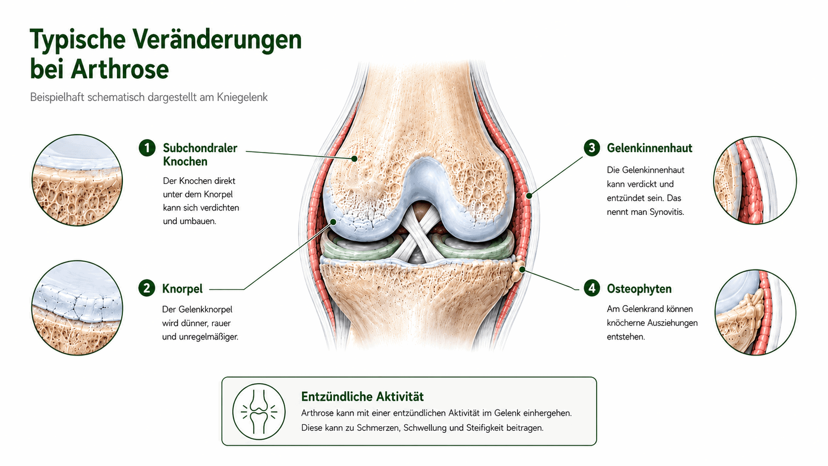 Vereinfachte Darstellung eines arthrotischen Gelenks mit Knorpel, Knochen, Gelenkinnenhaut, Osteophyten und leichten Entzündungsprozessen.